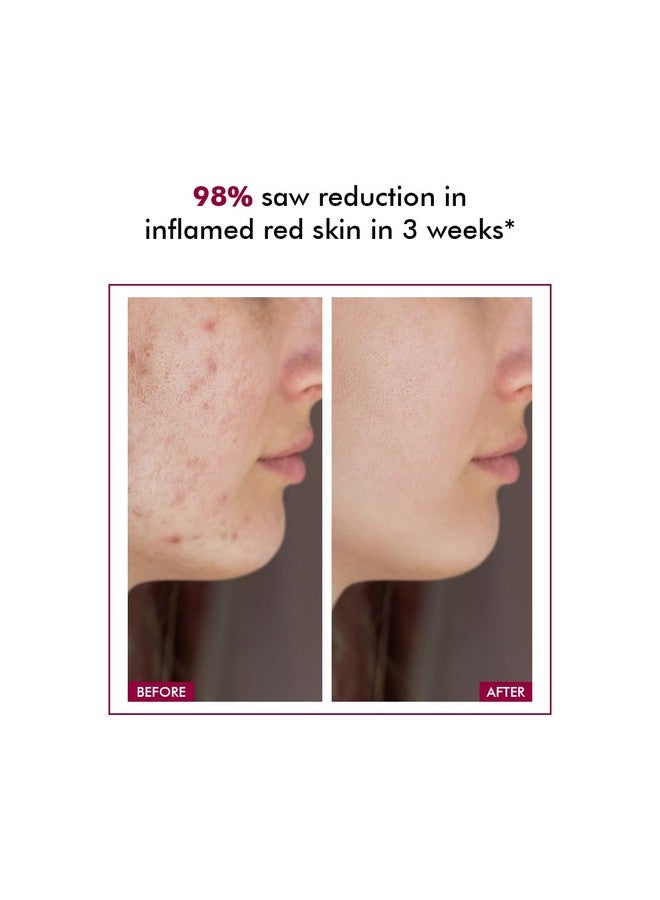 CONSCIOUS CHEMIST كريم حمض الأزيليك 10% من كونشس كيميست® | 50 جرام | كريم للوجه للرجال والنساء، مرطب للبشرة المعرضة لحب الشباب، تخفيف الاحمرار، تهدئة التهيج والالتهاب، لجميع أنواع البشرة - أزيكاليم - Image 3