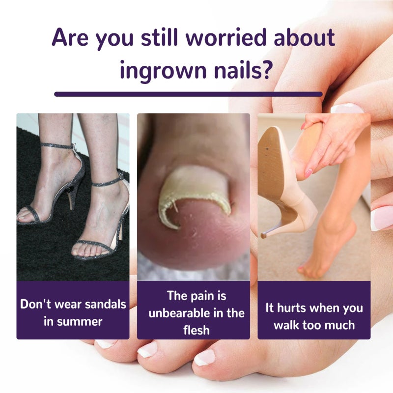 EELHOE Ingrown Toenail Correction Sticker 50Pcs Non-Woven Elastic Adhesive - No Grinding Nail-Friendly Breathable Comfortable Toenail Correction Sticker for Mild Moderate Severe Unilateral Ingrown Toenail Re - Image 4
