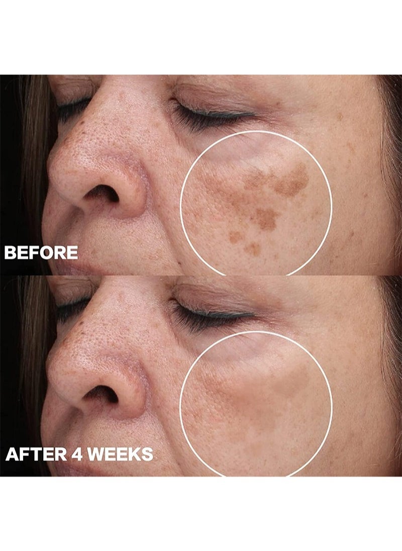 MOOYAM - Dark Spot Remover for Face, Dark Spot Corrector, Face Melasma Treatment, Hyperpigmentation Treatment, Freckle Remover with Niacinamide, Arbutin and Vitamin C/E/B5 1.7 fl oz, Cream - Image 1