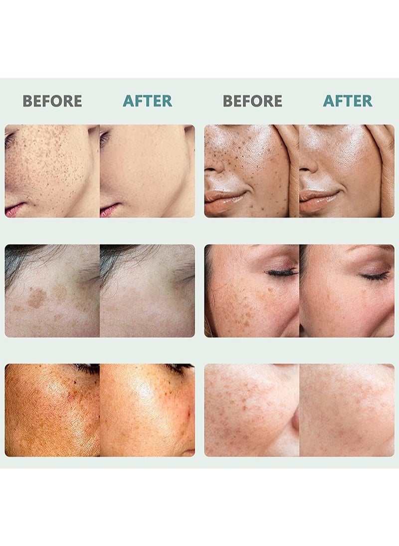 MOOYAM - Dark Spot Remover for Face, Dark Spot Corrector, Face Melasma Treatment, Hyperpigmentation Treatment, Freckle Remover with Niacinamide, Arbutin and Vitamin C/E/B5 1.7 fl oz, Cream - Image 1