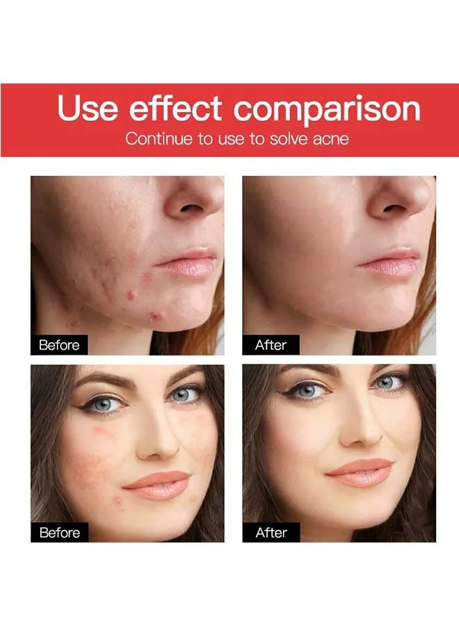 CARVENCHY 24 Patches Acne Pimple Master Patch ，Can Get Rid Of Acne Fast ，Invisible Isolation，Lighten Acne Marks，Soothes Red Acne，Suitable for all skin types - Image 3