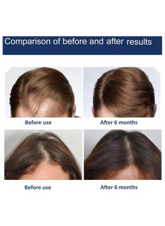 General Hair Growth Cap Anti-Hair Loss Helmet Electric Scalp Massager Infrared Light Therapy Hair Regrowth Treatment Hair Restoration Anti-thinning Cap Hair Loss Therapy  - Image 4