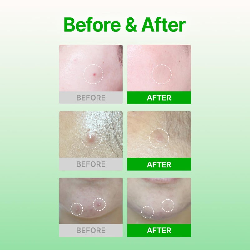 Acropass Trouble Care Microcone Acne Patch for Early Stage Pimple and Zits - Hydrocolloid, Niacimide Pimple Spot Treatment (Regular Size - 6count) - Image 3