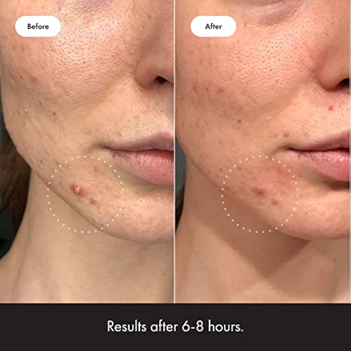 Mighty Patch™ Invisible+ Patch - Daytime Hydrocolloid Acne Pimple Patches for Covering Zits and Blemishes, Ultra Thin Spot Stickers for Face and Skin (24 Medium and 15 Small Patches) - Image 4