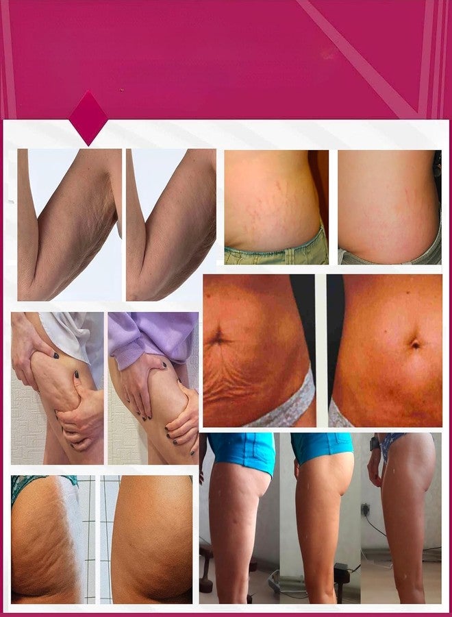 Anacis Anti-Cellulite Advanced Hot Body Cream Gel For Even Skin and Elasticity. Anacis - 5.07 Oz - Image 5