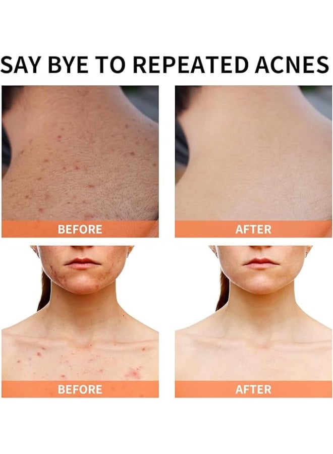YAFUSIPE Acne Treatment for Face, Acne Cream Back Acne Treatment Cream for Teens & Adults - Image 3