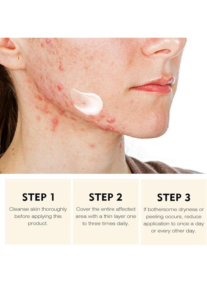 YAFUSIPE Acne Treatment for Face, Acne Cream Back Acne Treatment Cream for Teens & Adults - Image 4