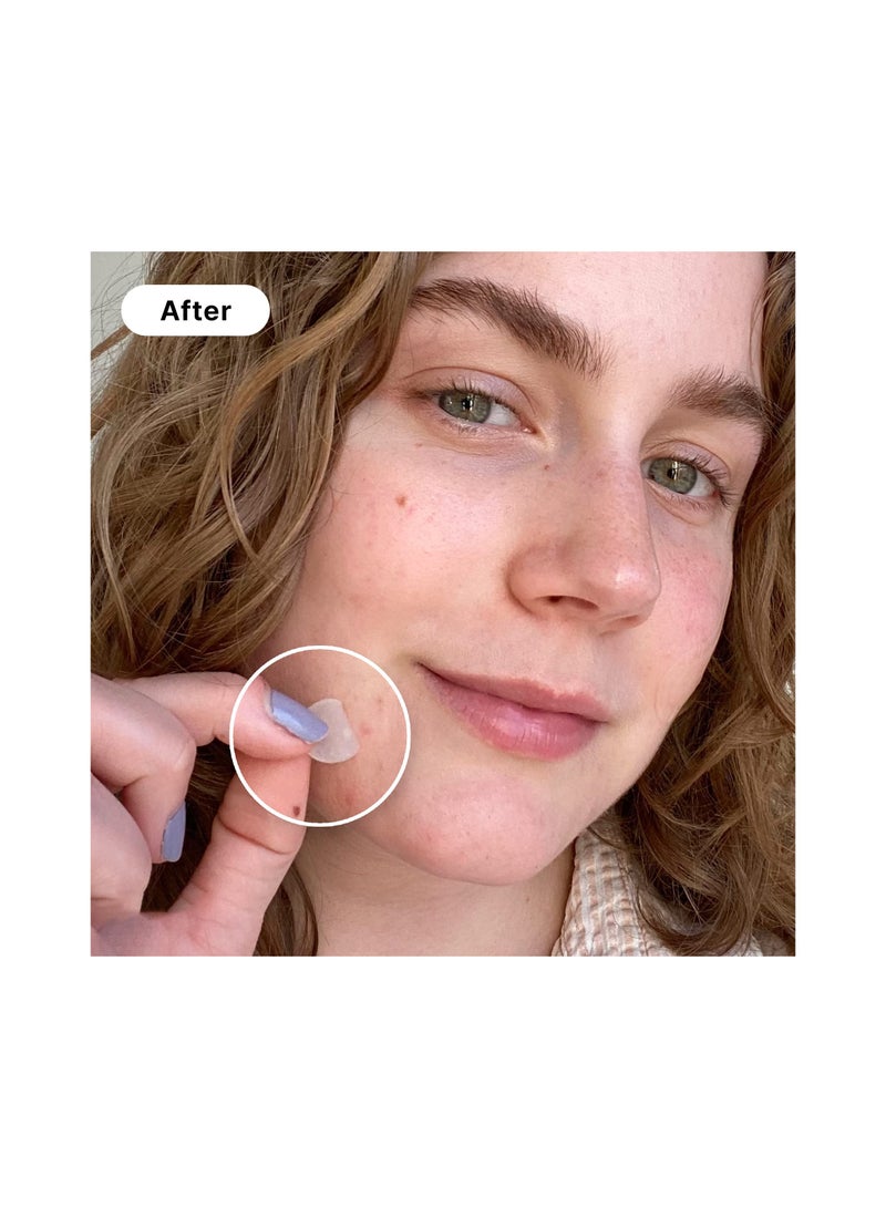 SYOSI 240 Count SYOSI Pimple Patches, 3 Sizes 10 Packs of Skin Tag Acne Removal Patches for Acne pimples of different sizes and shapes and for Blemish Moles Skin Tags, Absorbing and Cove. - Image 2