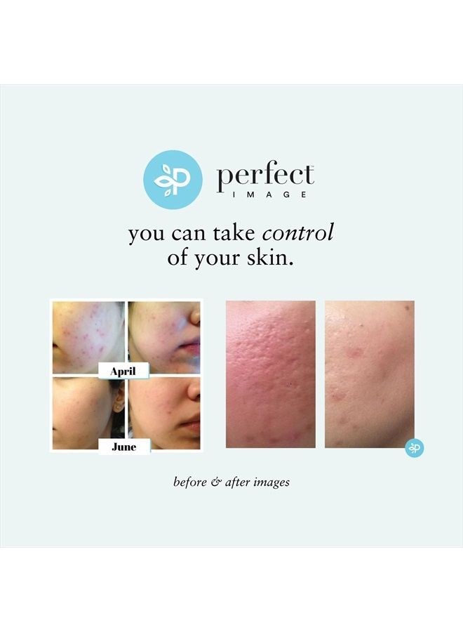 PERFECT IMAGE Lactic 50% Gel Peel, Chemical Peels for Face Breakout Scars, Chemical Exfoliant for Face, Strength Level 2, 1.0 fl oz. e, 30 mL – Perfect Image - Image 4