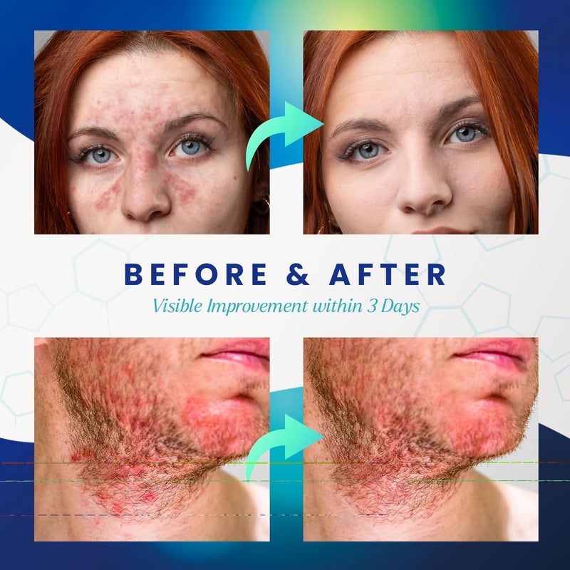 PureSkin كريم التهاب الجلد الدهني والصدفية: علاج مضاد للفطريات - مكون من أعشاب تقليدية - تخفيف لتهيج وتقشر فروة الرأس - خالي من الستيرويدات ونتائج دائمة 3.4 أونصة - Image 4