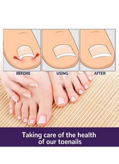 EELHOE Toenail Correction Patch Ingrown Nail Correction Repair Patch Repair Toe 50 Pcs  - Image 5