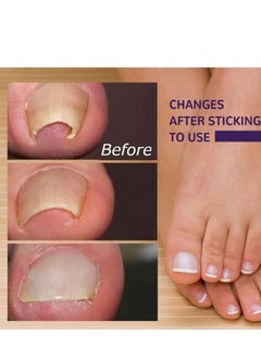 EELHOE Toenail Correction Patch Ingrown Nail Correction Repair Patch Repair Toe 50 Pcs  - Image 4