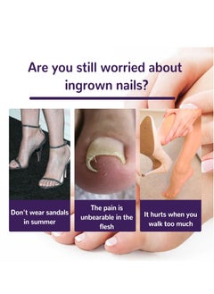 EELHOE Toenail Correction Patch Ingrown Nail Correction Repair Patch Repair Toe 50 Pcs  - Image 2