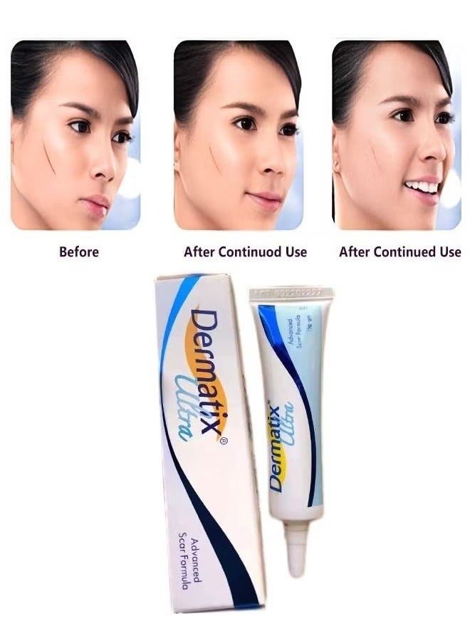 Dermatix Advanced Scar Gel 15g For Cosmetic Improvement of Scars, Fast Drying and Unique Silicone Gel Formulation, Used For Treatment of Keloids, Surgical and Hypertrophic Scars, Suitable For Sensitive Skin - Image 3