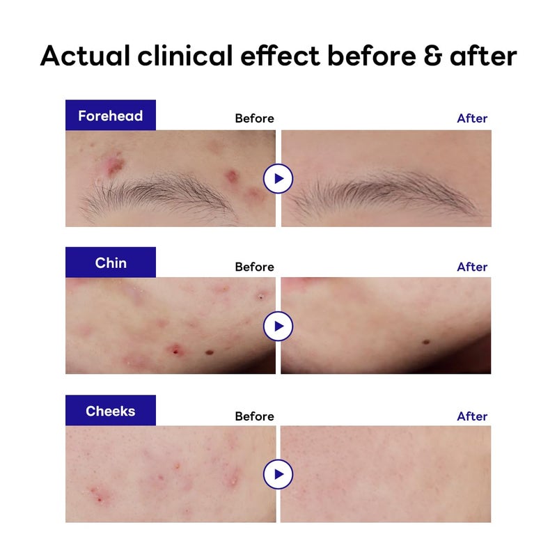 Mediheal Derma Clear Teatree Treatment Spot Patch (44 Counts) - Acne Relief, Oil and Moisture Balance with Teatree & Salicylic Acid - Image 3