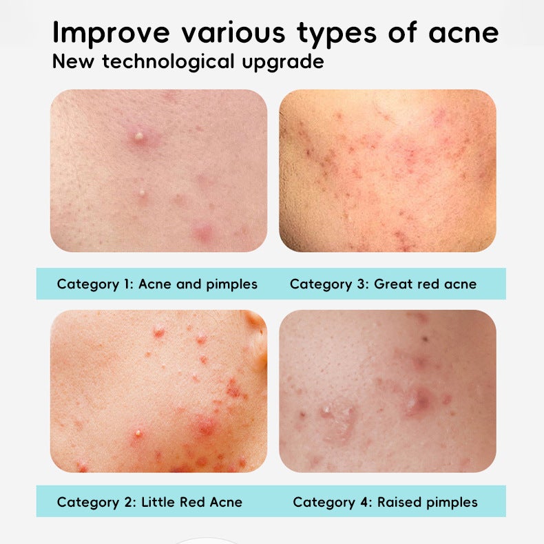 New Electronic Acne Patch for Home Beauty, Light Therapy to Reduce Pimples and Fade Scars, Compact and Portable - Image 4