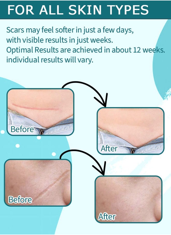 NIKITA.VIVI Clear Silicone Scar Sheets 1.5M Medical Grade Clear Gel Scar Tape Silicone Scar Strips Effective Scars Away Invisible Silicone Scar Sheets for Surgical Scars C Section Burn  - Image 3