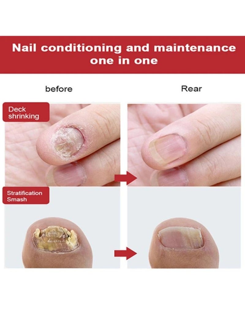 DERMFREE - Multi Purpose Nail Repair Fungus Treatment Toenail Fingernail Fungal Renewal Treatment Toenail Fungus Treatment Solution Nail Psoriasis Aging Nails Fungus Damaged Repair Gel 30ML - Image 1