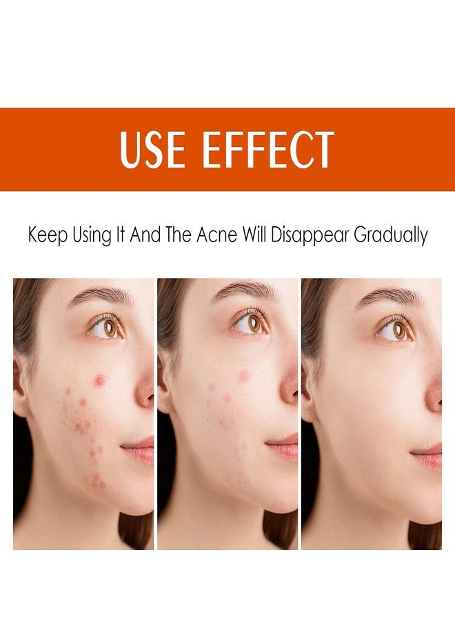 YAFUSIPE Acne Treatment for Face Hormonal Cystic Stubborn Acne Cream Back Butt Acne Spot Treatment for Teens Adults Moisturizer Pimple Rapid Clearing Cream for Breakouts Blemish Overnight 30g - Image 2