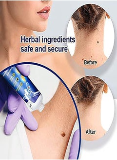 Sumifun Sumifun Wart Removal Cream, Skin Tag Remover for Common Warts Treatment, Effective and Safe (1PCS)  - Image 3