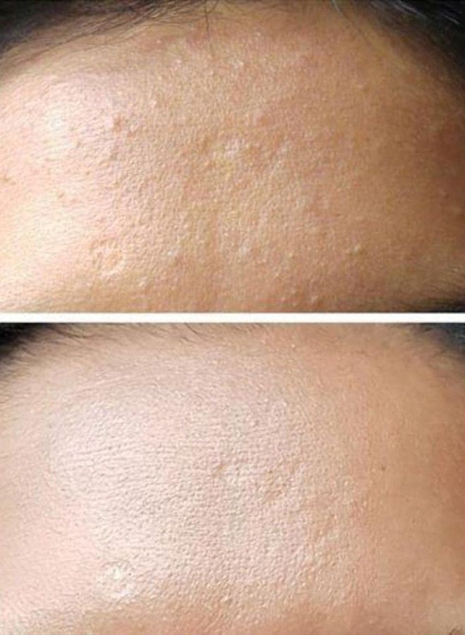 BENTON ALOE BHA Skin Toner 200ml 1pcs - Image 3