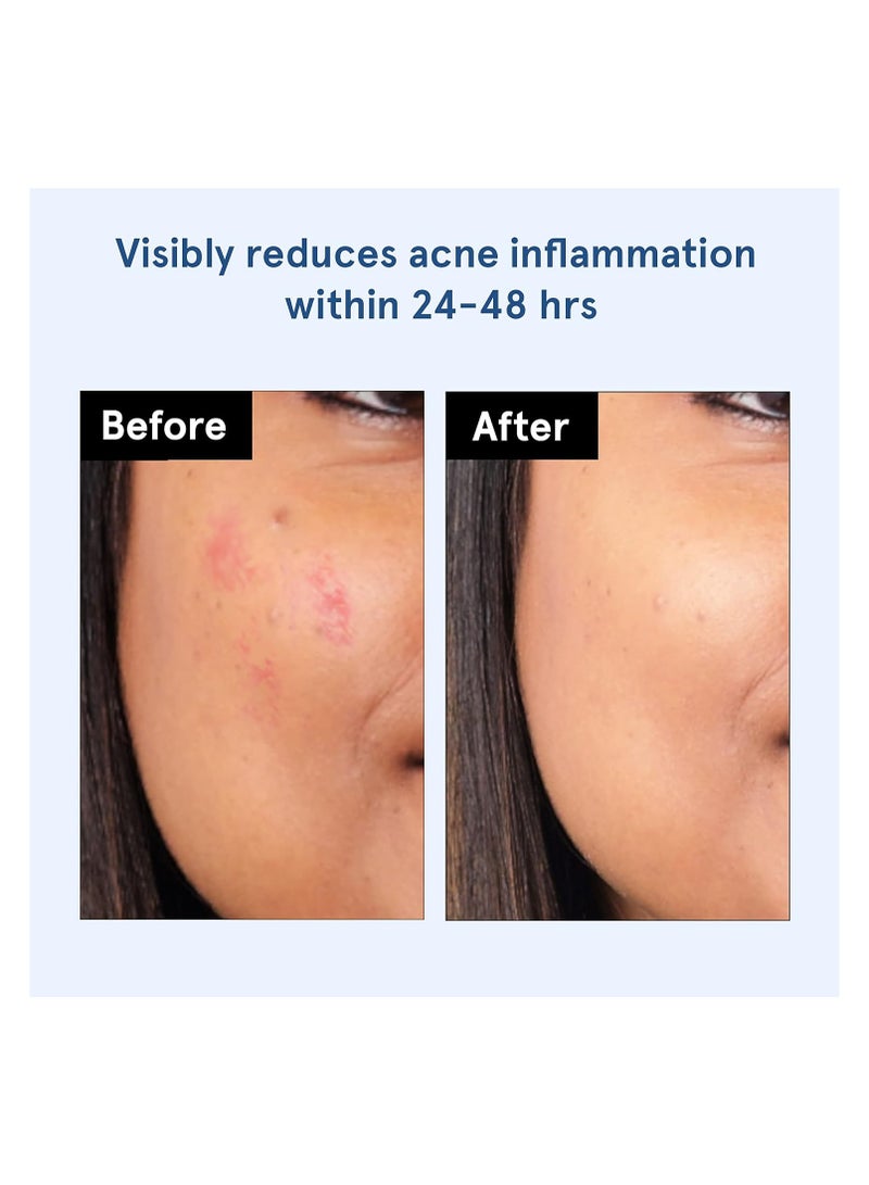 Be Bodywise Bodywise Be Bodywise Acne Pimple Patch For Women (24 Dots | 3 Sizes) | Absorbs & Flattens Acne Overnight | Waterproof | Reduces Excess Oil, Shrinks Pimples & Clears Pores | For All Skin Type - Image 3