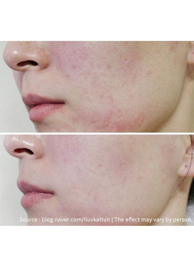 BONAJOUR - [BONAJOUR] Vegan beauty Derma MDK Cica Repair Serum for Acne Skin, Enriched Face Extreme Repair Ampoule - Acne Scar Remover 13g - Image 1