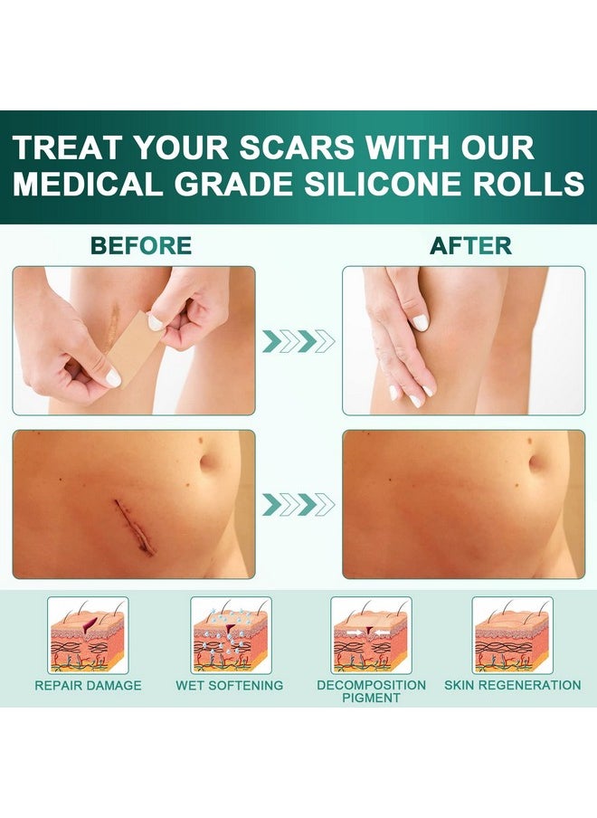AirroYE - Silicone Scar Sheets,Silicone Scar Tape(1.6"X 120" Roll-3M), Reusable And Effective Scar Removal Sheets, Silicone Scar Removal Sheets For Surgical Scars,Healing Keloid, C-Section, Tummy Tuck - Image 1