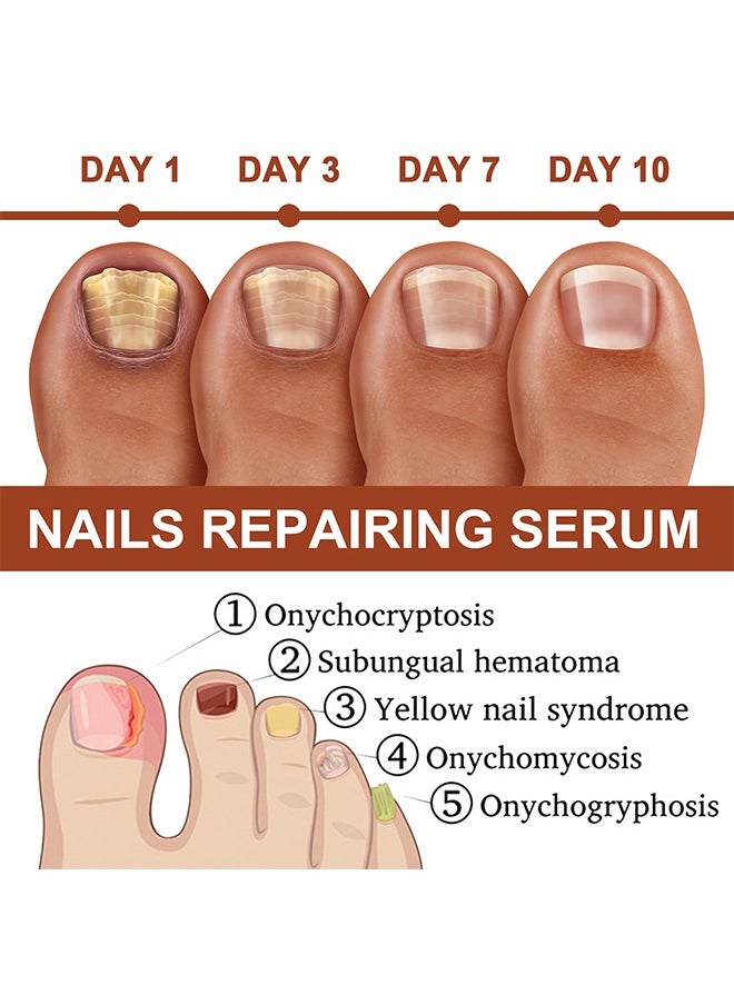 Jaysuing - 7Days Nails Repairing Serum, Nail Nutrient Oil Strengthener Oil Serum Nail Growth Oil, Nail Cuticle Oil Strengthener, Nail Serum For Growth And Repair For Damaged Nails, 20ML - Image 1