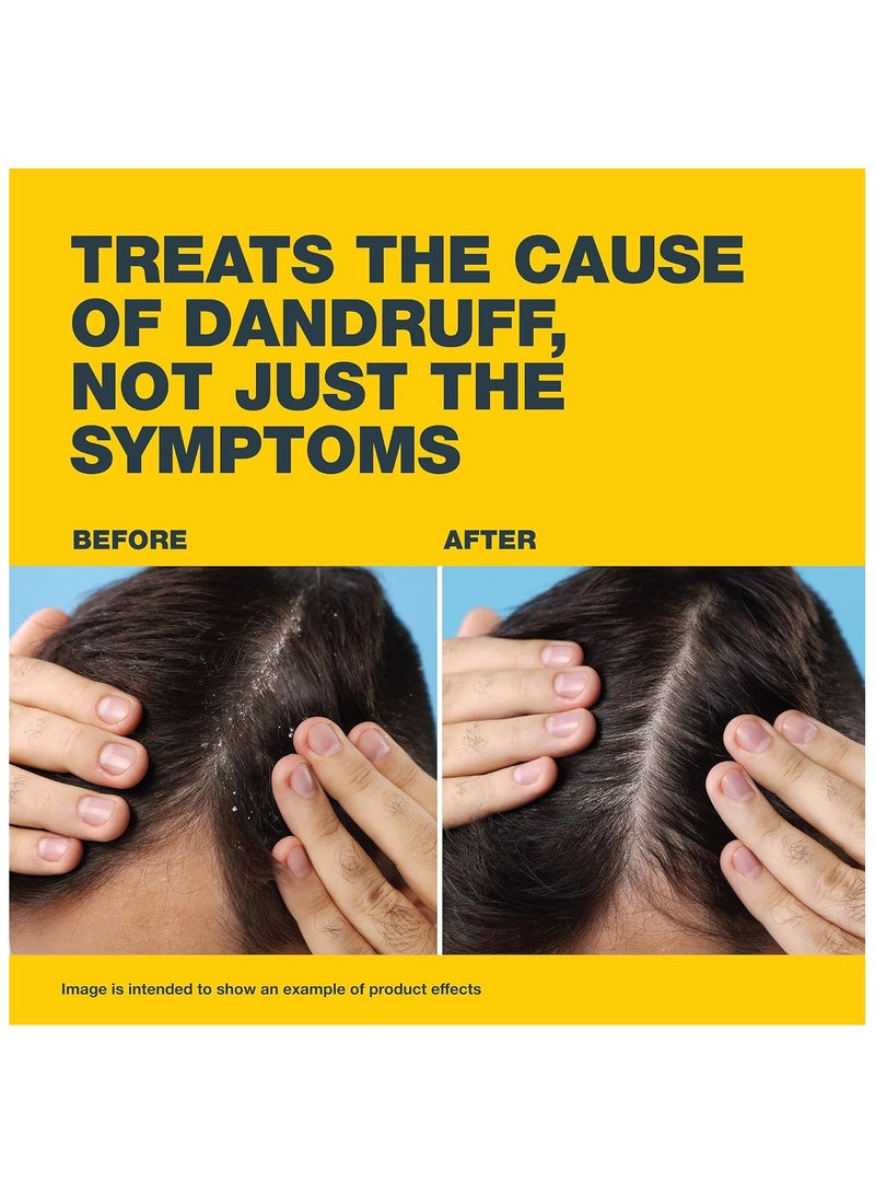 Nizoral Anti-Dandruff Treatment Shampoo, 100ml | Unisex Medicated Shampoo for Men & Women | Effective Dandruff Treatment | Works From the First Wash | Clinically Proven Ketoconazole Shampoo to Relieve Itchy Scalp - Image 3