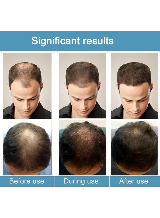Liexuan Alphainfuse Hair Regrowth System, Advanced Hair Growth Treatment Serum for Thicker, Fuller Hairs, Strengthens Roots, Gentle Painless, Supports Healthy Hairs Growth for Men & Women (1Pcs) - Image 2