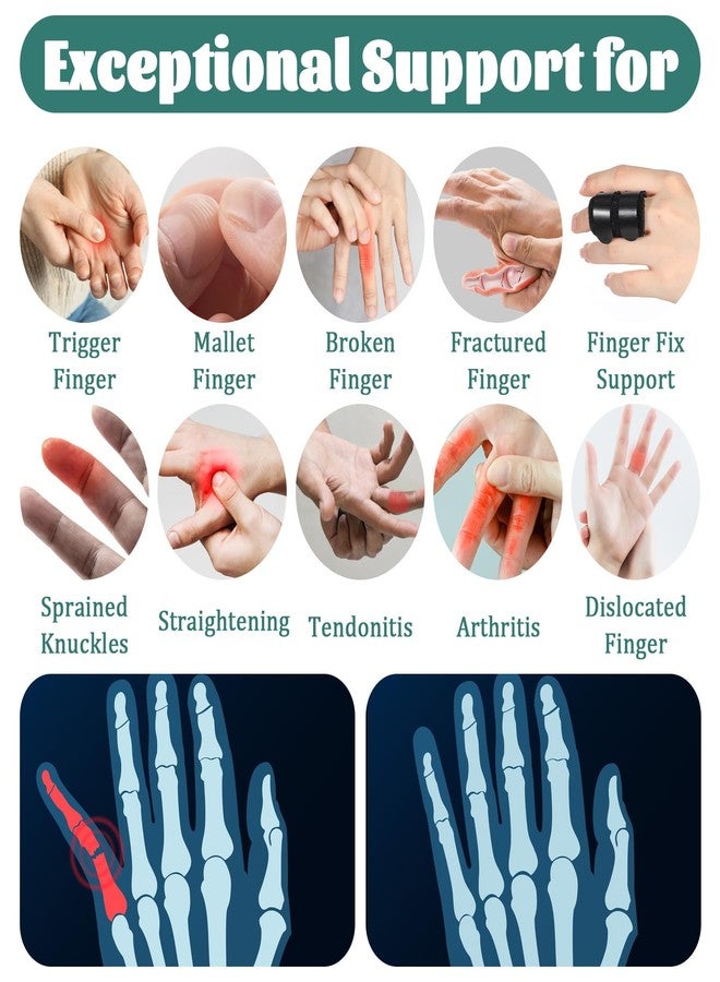 Azefnuhk 5 PCS Trigger Thumb Splints, Finger Brace for Support Fingers, Knuckle Straightening Immobilizer for Women Men Thumb Index Middle Ring Pinky Fingers Sprains Injuries Discomfort - Image 5