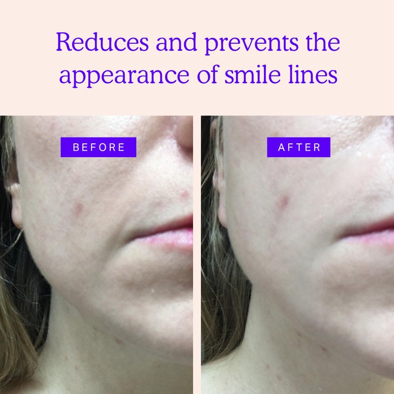 BLUMBODY Smile Line Patches â€“ Face Wrinkle Patches for Fine Lines Around Mouth, between Eyes â€“ Non-Silicone Anti-Wrinkle Facial Tape â€“ Comfortable Overnight Use (90-Day Supply) - Image 2