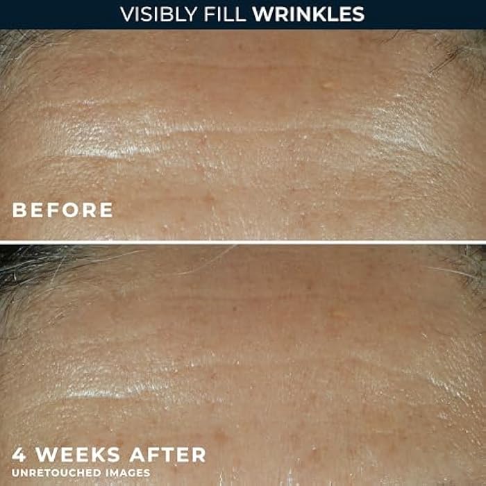 RoC Retinol Correxion Wrinkle Filler for Deep Wrinkles with Hyaluronic Acid & Retinol, Skin Care for Women and Men, 1 Fl Oz (Packaging May Vary) - Image 4