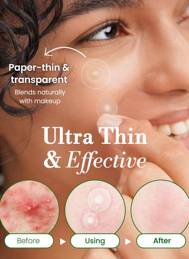 Troubless Invisible Pimple Patch Classic, 96 Patches (2 Sizes) – Ultra Thin Hydrocolloid Spot Treatment for Daytime Use, Easy Peel, Fast Healing, Absorbs Oil & Impurities, For Acne-Prone Skin - Image 5