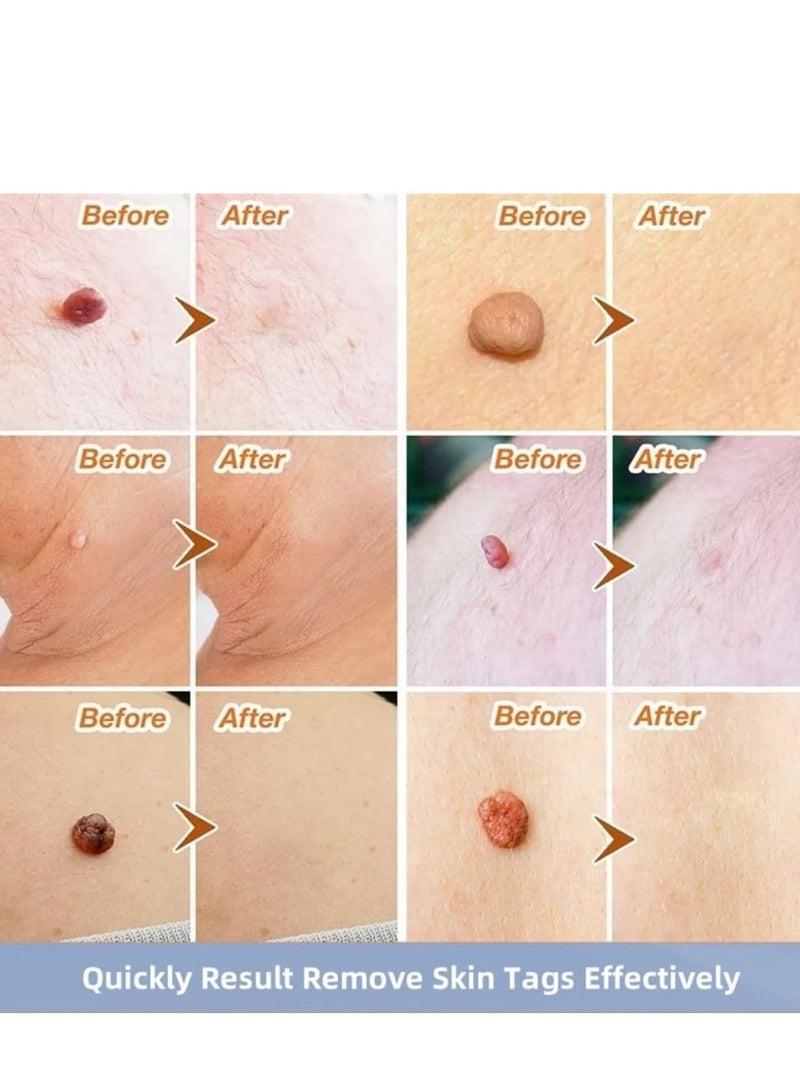 EELHOE 144PCS Wart Removal Patches, Natural Wart Remover Plasters, Mole and Skin Tag Removal Pads, Pain-Free Wart Treatment for Hands, Face, and Body - Image 3