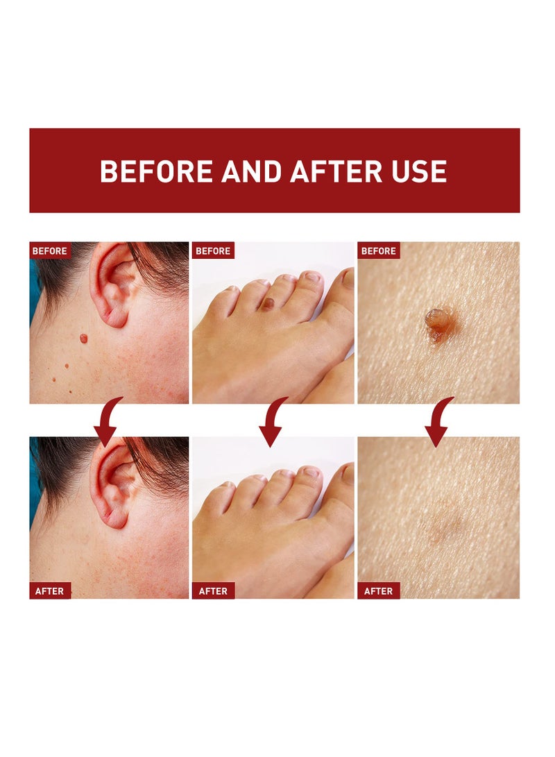 EELHOE Organic Skin Solutions Serum for Lighten Skin Moles and Eliminate Warts  - Image 4