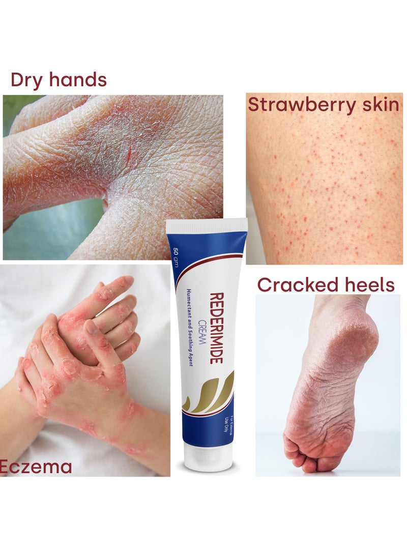 UBM Rederimide Cream 10% Urea - For Cracked Heels, Dry Knees, Strawberry Skin, Exfoliation, Toning & Excessive Dryness. - Image 2
