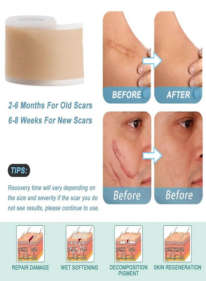 Silicone Scar Sheets, Self-Adhesive Scar Tape, Silicone Sheets For Scars, Scar Tape For Surgical Scars, Keloid Bump Removal, Cesarean Surgery Scar Removal(1.6"x 118" Roll) - Image 3