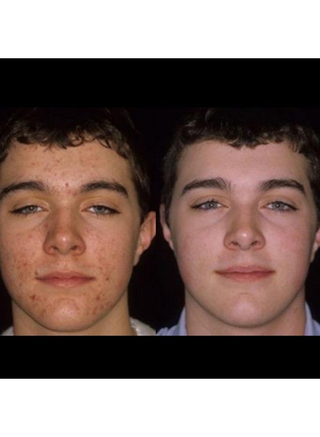 Acnetame 4 Pack- Vitamin Supplements for Acne Treatment- Hormonal Pimple Tablets to Clear Oily Skin for Women, Men, Teens, and Adults - Image 5