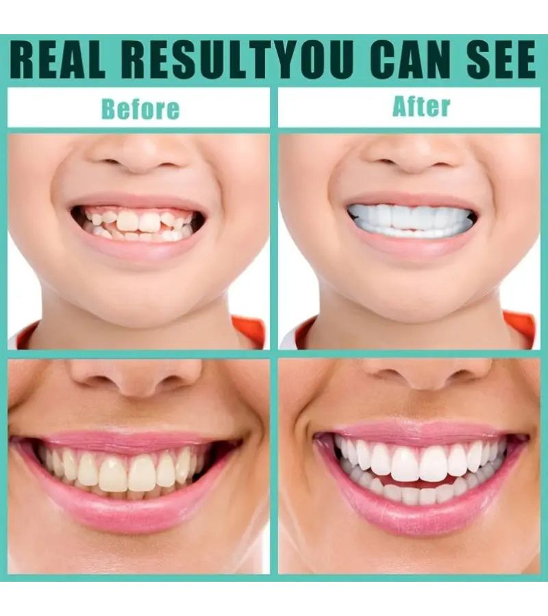 White Teeth Veneers Premium Edition Unisex Upper Lower Dental Set - Image 4