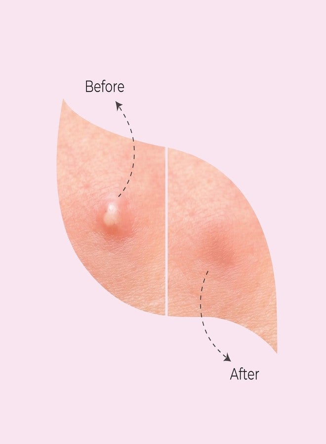 Perr Cherry Pimple Patch | 40 Hydrocolloid Patches | Absorbs Oil, Prevents Scarring | For All Skin Types | Acne Patches for Face (Pink, 40) - Image 4