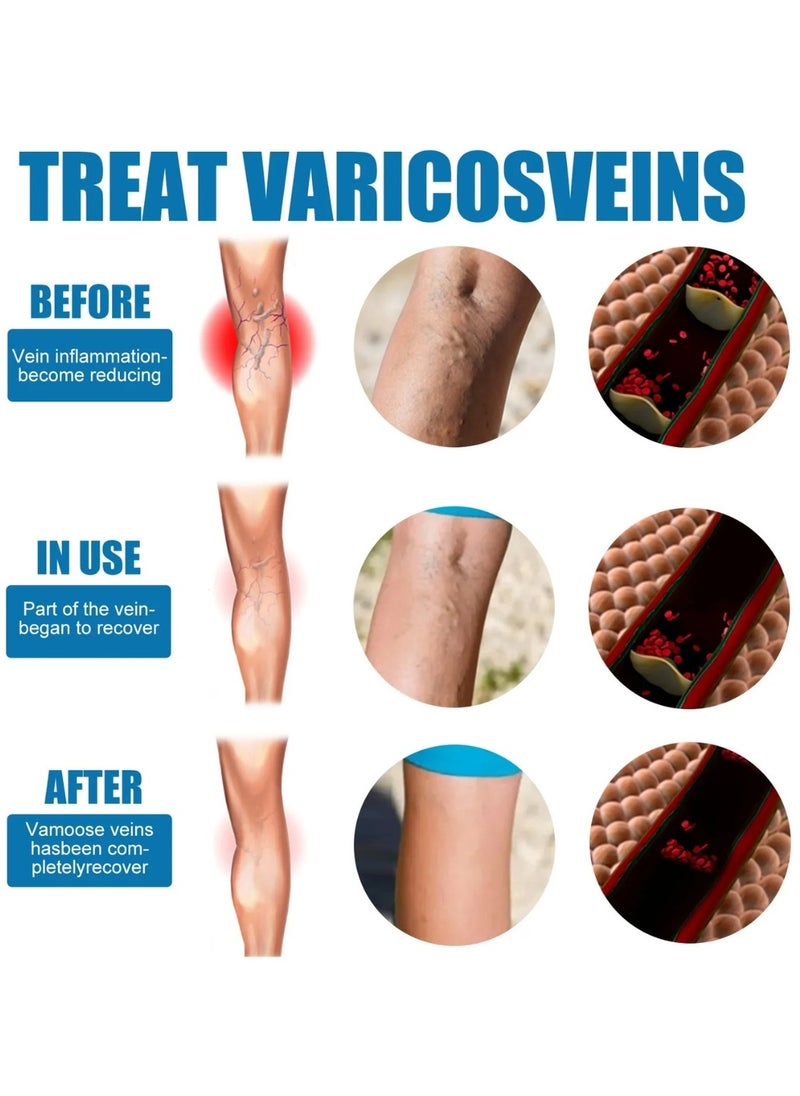 SOUTH MOON - Varicose Veins Treatment Spray Vein Healing Varicose Veins Spray Varicose Veins Oil for Legs Varicose Veins Miracle Spray Improve Blood Circulation Varicose Vein Repair Cream 30ml - Image 1