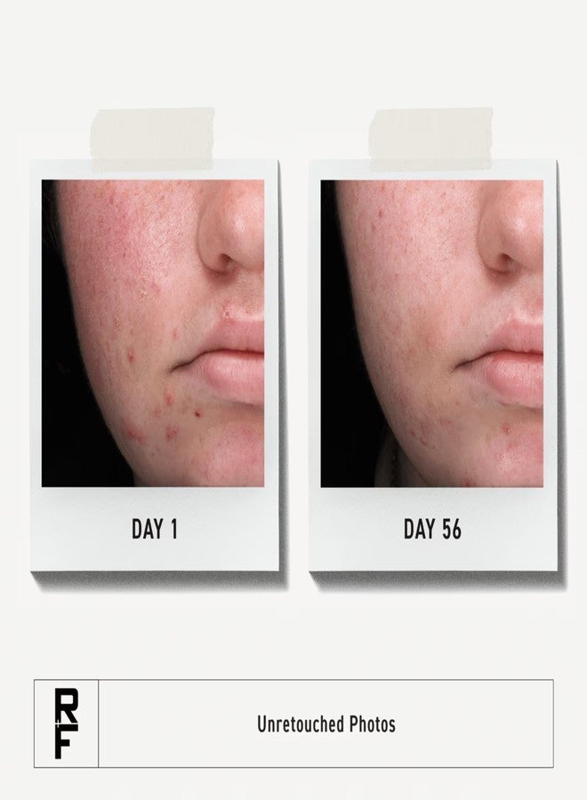 Rodan Fields Rodan + Fields Spotless Regimen | Benzoyl Peroxide Face Wash for Sensitive Skin | Skincare Sets & Kits | Skin Care for Adults & Teens with Stubborn Acne | All Skin Types - Image 2