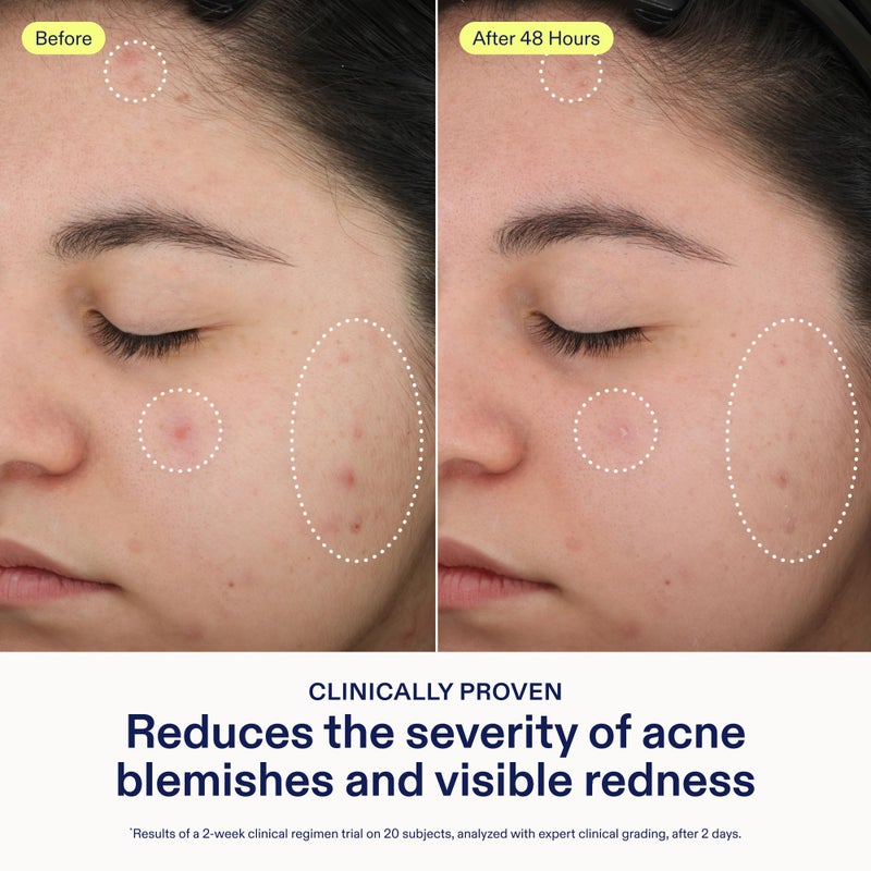 Skinfix علاج البقع 2% BHA من سكين فيكس - 0.5 أونصة سائلة - يزيل عيوب حب الشباب والرؤوس السوداء مع النياسيناميد - خالي من العطور - نباتي، خالي من القسوة - Image 3