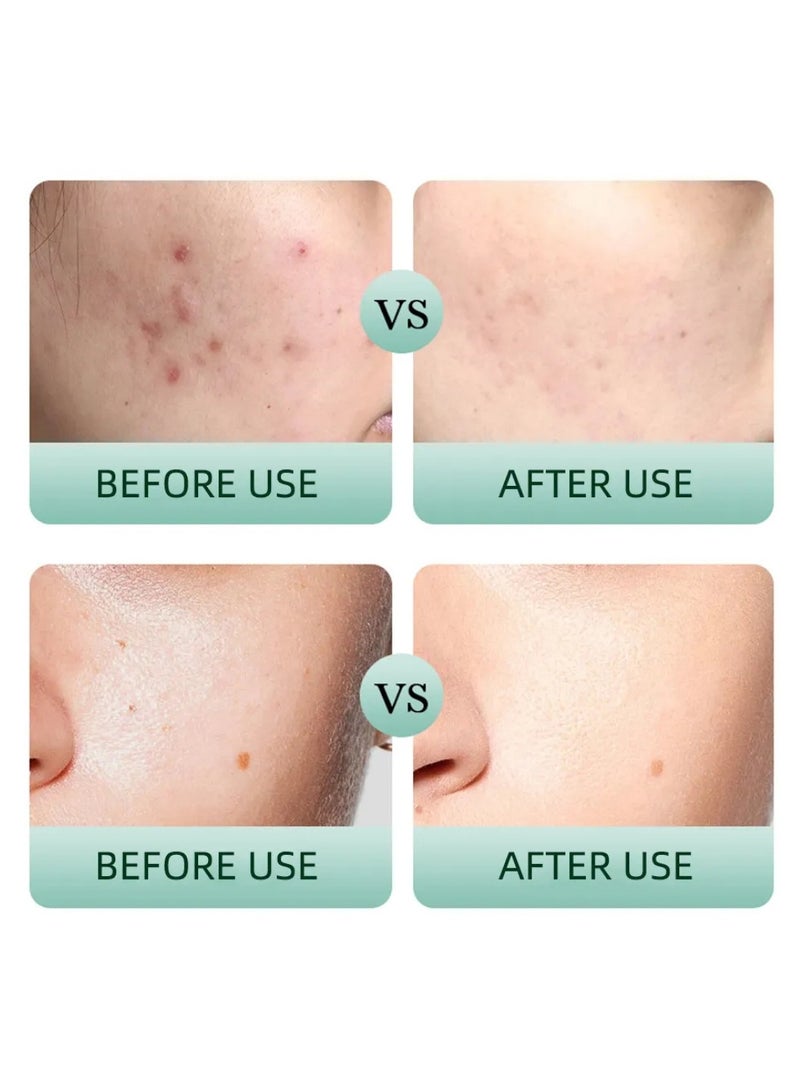 MOOYAM Tea Tree Salicylic 30 Days Anti Acne Set Tea Tree Acne Treatment Skin Care Kit Salicylic Acid Skin Care Set Acne Treatment for Face Tea Tree Salicylic Acid Face Serum Clean Foam Soothing Face Toner and Face Cream Anti Acne Gift Kit  - Image 2