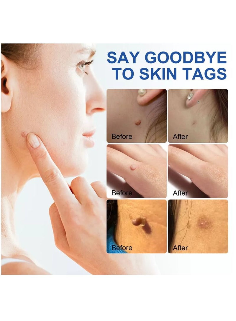Sefudun Auto Skin Tag Remover Painless & Fast Removal Kit for Large Size Skin Tags Remover (4mm - 9mm) Safe Tag Remover Skin for Body & Face  - Image 4