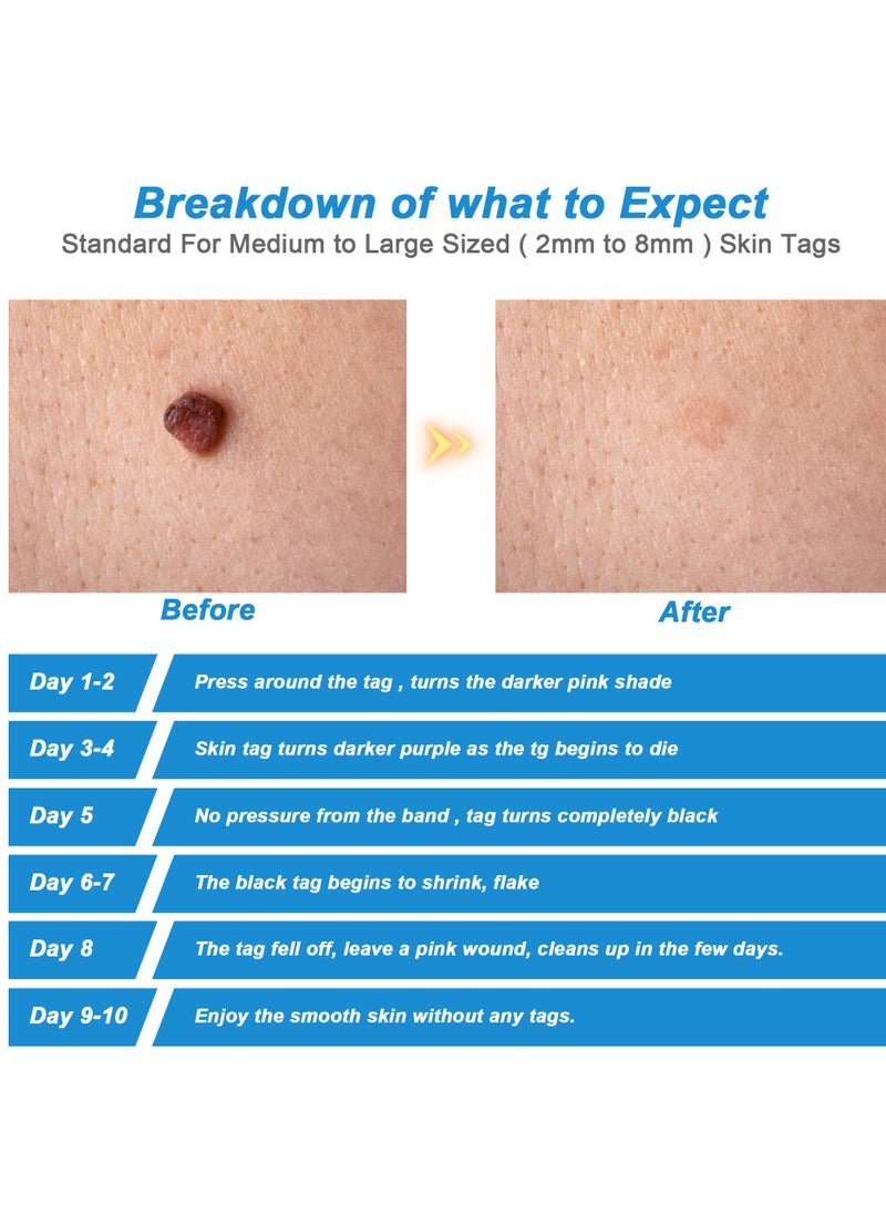 Sefudun - Painless and easy to use wart removal tool double ended blue: Effectively removes skin markers, corn kernels, warts and meatballs from the face, neck and whole body for skin problems of all sizes - Image 1