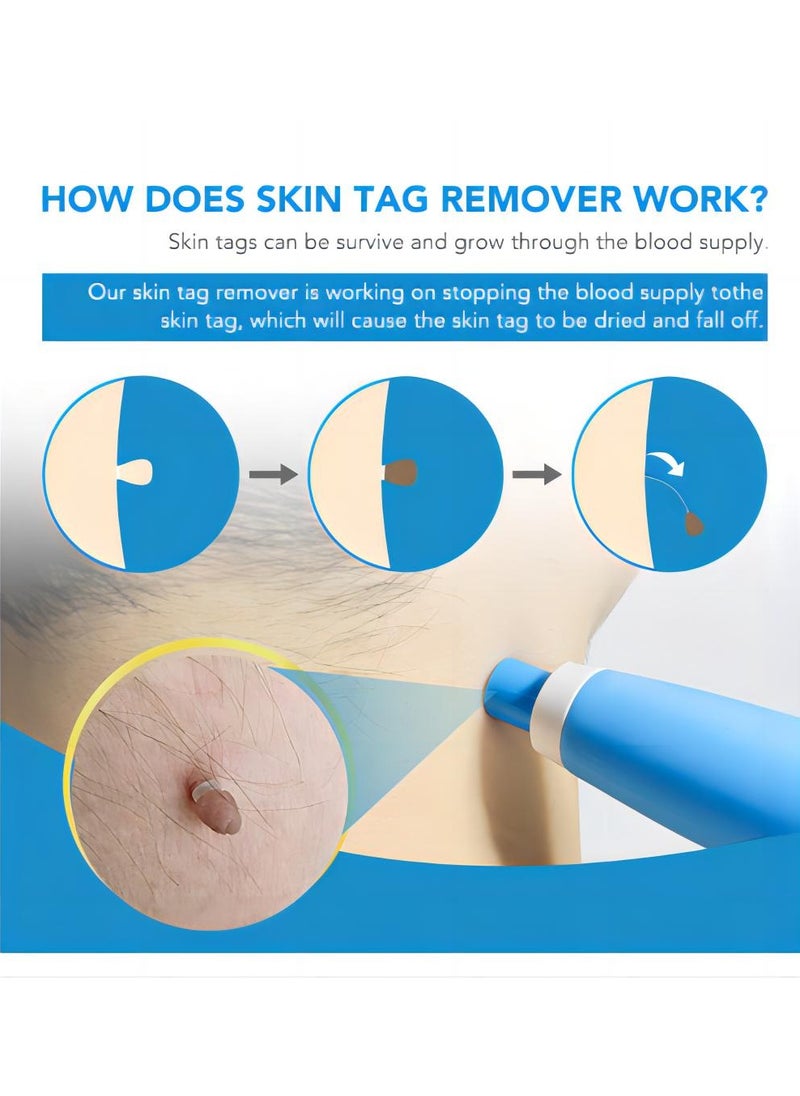 Sefudun - Painless and easy to use wart removal tool double ended blue: Effectively removes skin markers, corn kernels, warts and meatballs from the face, neck and whole body for skin problems of all sizes - Image 1