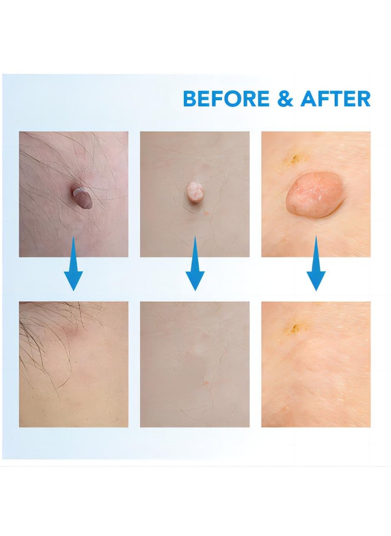 Sefudun - Painless and easy to use wart removal tool double ended blue: Effectively removes skin markers, corn kernels, warts and meatballs from the face, neck and whole body for skin problems of all sizes - Image 1